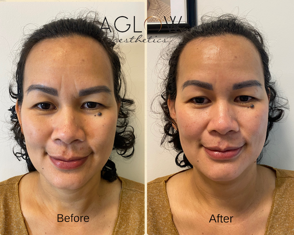 HYDRA FACIAL Aglow Aesthetics